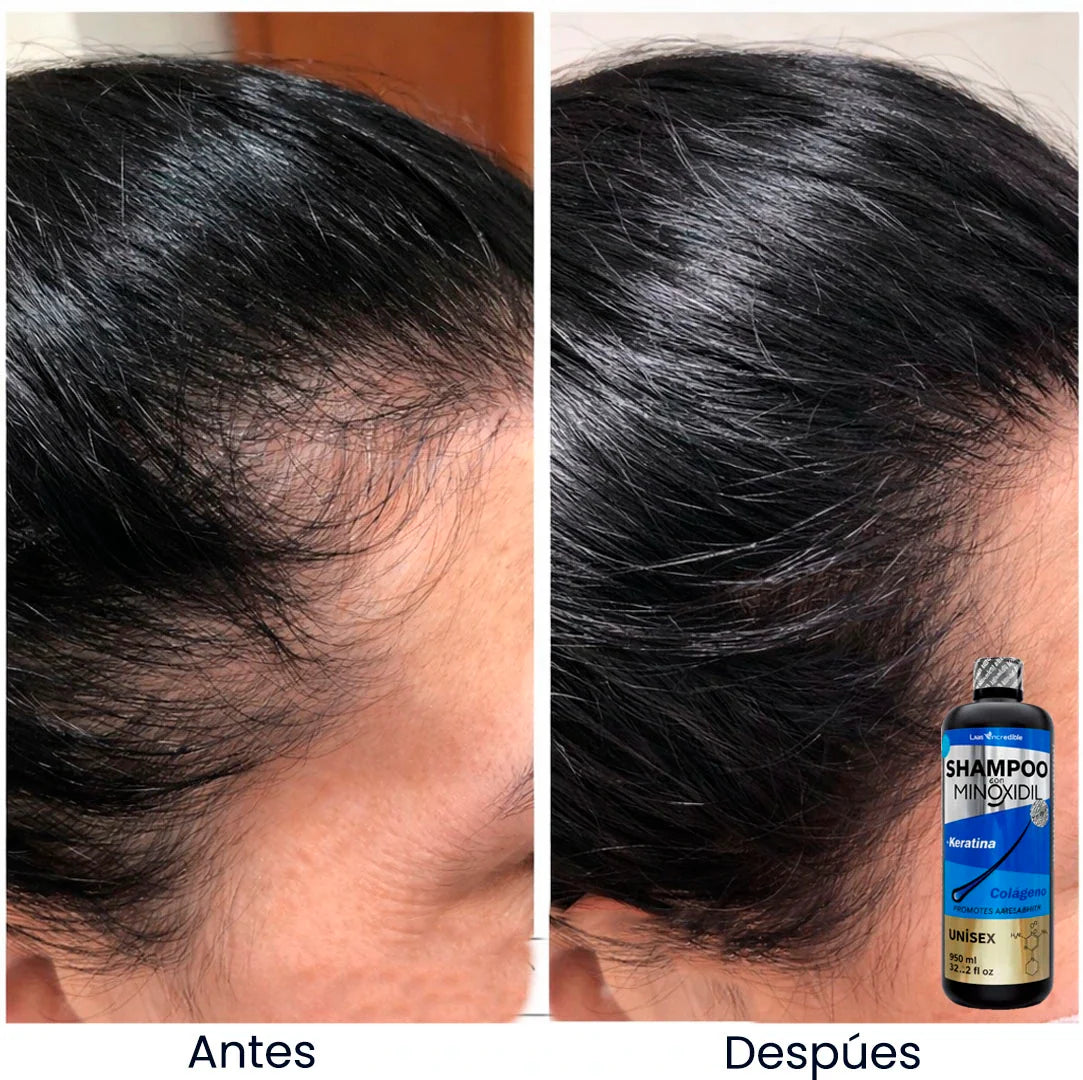 ¿Estrés y ahora caída del cabello?